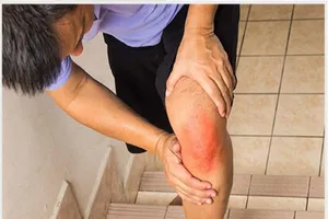 Cẩn trọng khi trị thoái hóa khớp bằng thuốc dân gian