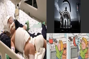 Mắc dây ấm đun siêu tốc, bé 20 tháng tuổi bỏng nặng