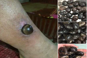 Thực hư hạt đậu lào 'thần thánh' hút nọc rắn, trị chó dại cắn