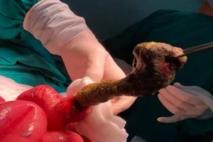 Mắc bệnh ăn tóc kỳ lạ, bé gái 6 tuổi tắc búi tóc to trong ruột