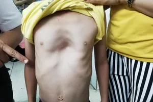 Lần đầu tiên BV Nhi đồng 2 thực hiện ca phẫu thuật '2 trong 1'