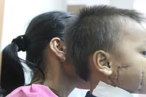 Kinh hoàng bé trai bị cánh quạt công nghiệp cắt thấu xương hàm