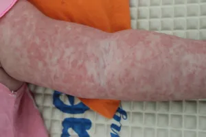 Liên tiếp trẻ dưới 9 tháng tuổi mắc sởi nhập viện tại TP.HCM