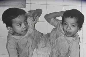 30 năm ngày tách rời cặp song sinh Việt-Đức đi vào lịch sử