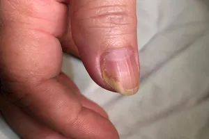 Người phụ nữ 5 năm treo tay lên đầu giường để ngủ