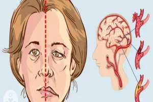 Hỏi đáp miễn phí về đột quỵ cùng chuyên gia