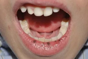 Môi có sắc tố lạ cảnh báo hội chứng dễ dẫn đến ung thư