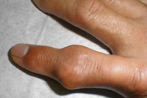 90% người bệnh gút đang lạm dụng thuốc có corticoid