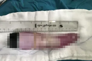 Cứu thanh niên bị mắc kẹt 'của quý' giả