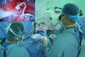 Người đàn ông yếu liệt vì sán nhái 7 cm chui lên não