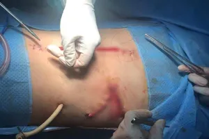 Kích hoạt báo động đỏ cứu thanh niên vỡ nhiều tạng nguy kịch