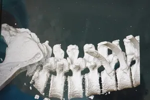 Té trượt đốt sống lưng từ nhỏ, chịu đựng gần 70 tuổi mới mổ