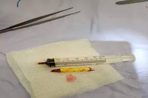 Bé gái bị bút chì đâm xuyên qua mũi khi giành nhau với chị