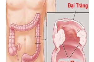 Làm sao để phòng tránh ung thư đại trực tràng?