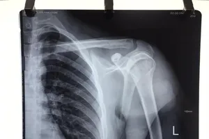 3 giờ vi phẫu nối dây thần kinh cứu cánh tay cho chàng trai