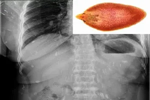 Đau thắt lưng, đi khám ra sán lá gan lớn sinh sôi khắp cơ thể 