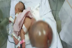 Cân não cắt khối u quái nặng hơn cơ thể bé sơ sinh 