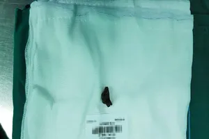 Mảnh đạn 40 năm nằm trong ổ bụng tạo ổ áp xe khổng lồ