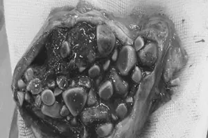 Lấy hàng trăm viên sỏi mật cho nữ bệnh nhân người nước ngoài