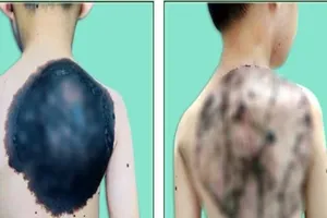 U hắc tố khổng lồ 'ăn' gần hết lưng bé trai