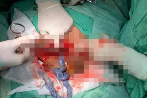 Báo động đỏ cứu bé gái thai suy vì dây rốn thắt nút