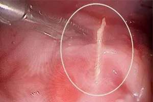 Nguyên nhân không ngờ làm bé trai thủng ruột nhiễm trùng nặng