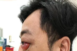 Chàng trai đột nhiên lồi mắt, suýt mù sau 2 năm bị té