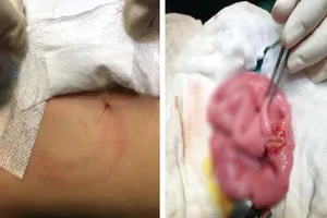 Bé bốn tuổi vỡ ruột nguy kịch do anh ném lon bia vào bụng