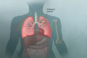 Tầm soát và phòng ngừa ung thư phổi sao cho hiệu quả? 