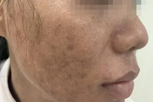 Trẻ hóa da bằng laser: Coi chừng già và xấu hơn!