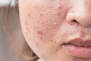 Nên hay không sử dụng kháng sinh trị mụn trứng cá