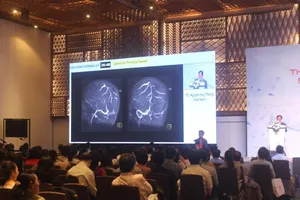 Cảnh giác thiếu máu não thoáng qua gây đột quỵ