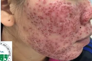 Mặt tiền tan nát, vỡ mộng trắng sáng vì lột da bằng hóa chất