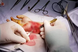 Té trúng viên gạch vỡ, cổ tay bé trai gần đứt lìa 