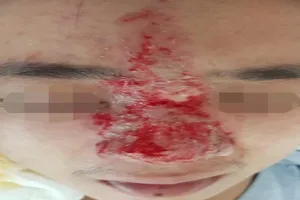 Thêm 1 người có nguy cơ mù mắt sau khi tiêm filler nâng mũi