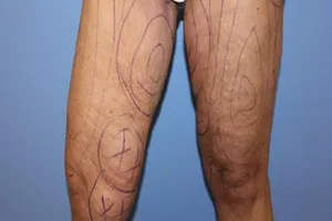 Thanh niên nhập viện sau khi hút mỡ đùi