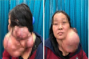 Khối u biến hình khổng lồ, hóa ác tính sau 25 năm