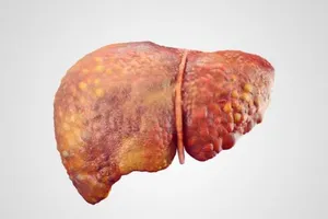 Người Việt Nam ung thư gan chết gấp 3 lần tai nạn giao thông