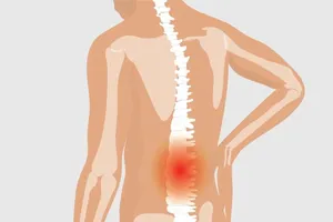 Cảnh báo viêm khớp cột sống gây tàn phế người trẻ