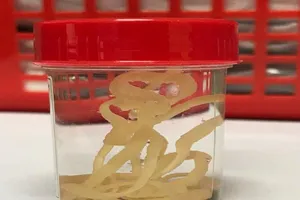 Quen ăn bò tái, người đàn ông 'nuôi' con sán dây hơn 1 m