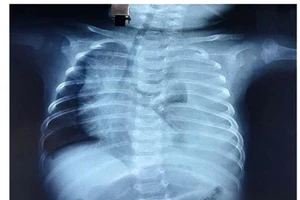 Bé 3 tháng bị rò nửa lít dịch đục như sữa vào phổi mỗi ngày