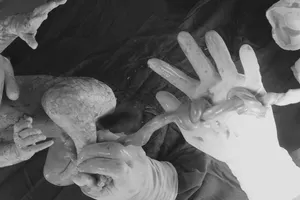 Mổ khẩn cứu bé gái dây rốn bị thắt nút tới 2 chỗ 