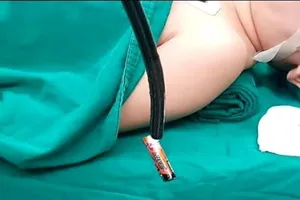 Nuốt xong cục pin, bé trai 4 tuổi nói ra cha mẹ mới hay