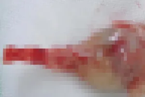 Phát hiện 1 thai nhi mắc hội chứng người cá