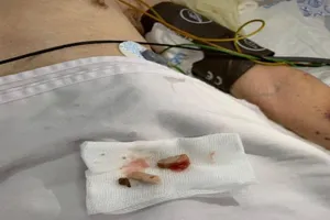 Cảnh báo liên tiếp người lớn tuổi ăn uống bị hít sặc tử vong