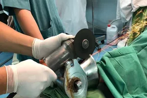 Bác sĩ cưa máy xay thịt giải cứu bàn tay cho bệnh nhân