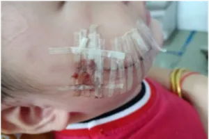 Vết thương dài trên mặt bé sau khi được xử lý và khâu lại. Ảnh: BVCC