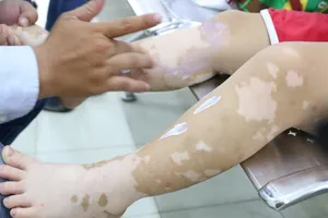 Tại sao da lại có những mảng trắng? 