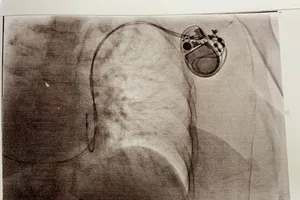 Cụ bà đảo ngược phủ tạng hoàn toàn hiếm gặp