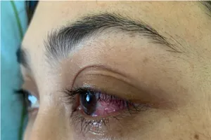 Căn bệnh không ngờ khiến mắt cô gái suýt mù 